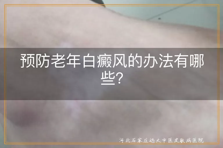 老年白癜风,预防,防晒,均衡饮食,精神压力,皮肤检查,药物使用,生活习惯