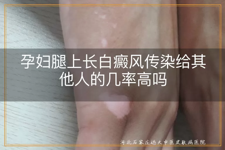 白癜风,孕妇,传染,遗传,科学治疗,生活习惯,心态