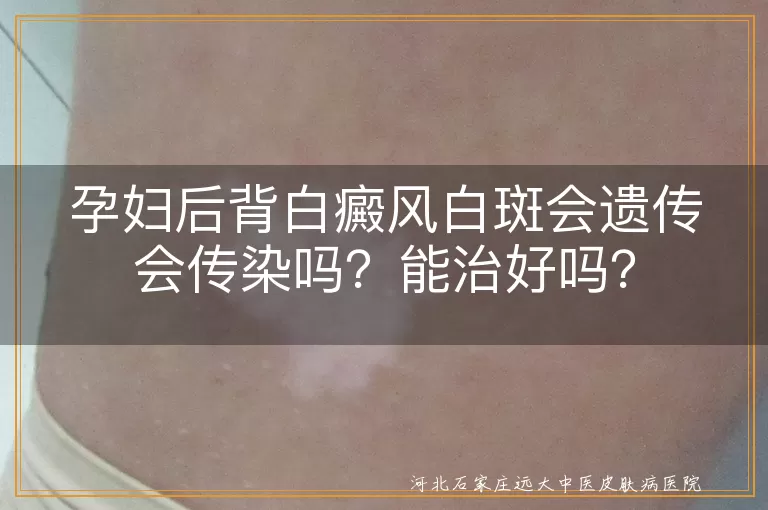 孕妇,白癜风,白斑,遗传,传染,治疗,药物,安全性