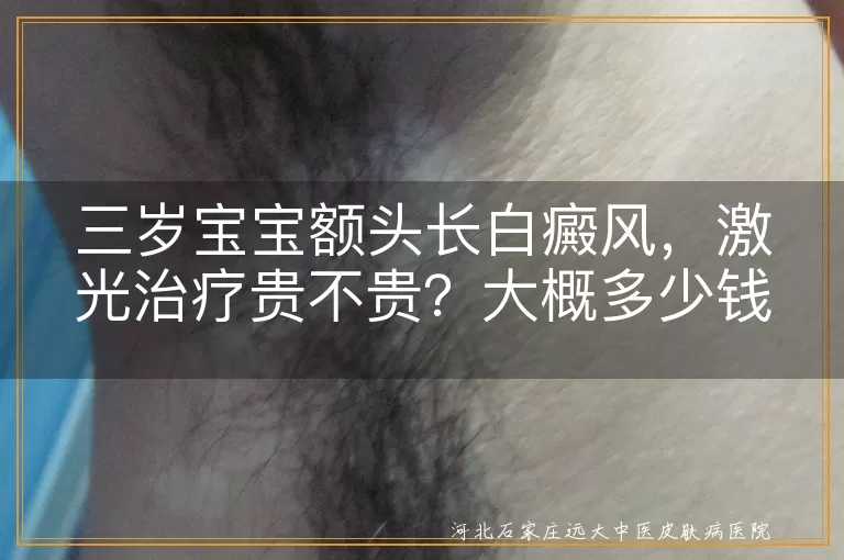 三岁宝宝,白癜风,激光治疗,费用,治疗效果,安全性,综合治疗,身心健康