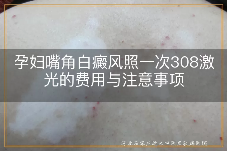 孕妇白癜风,308激光治疗,费用,注意事项,防晒,复诊