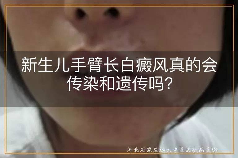 白癜风,新生儿,传染,遗传,治疗,护理