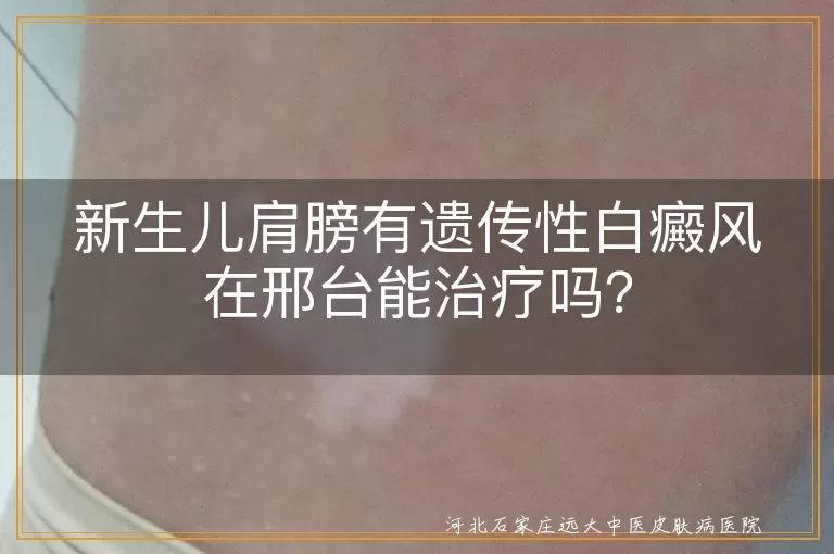 新生儿,遗传性白癜风,邢台治疗,药物治疗,光疗,手术治疗,家长配合