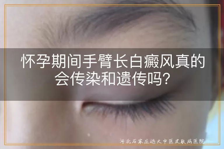 怀孕,白癜风,传染,遗传,治疗,防晒,饮食均衡,心态调整