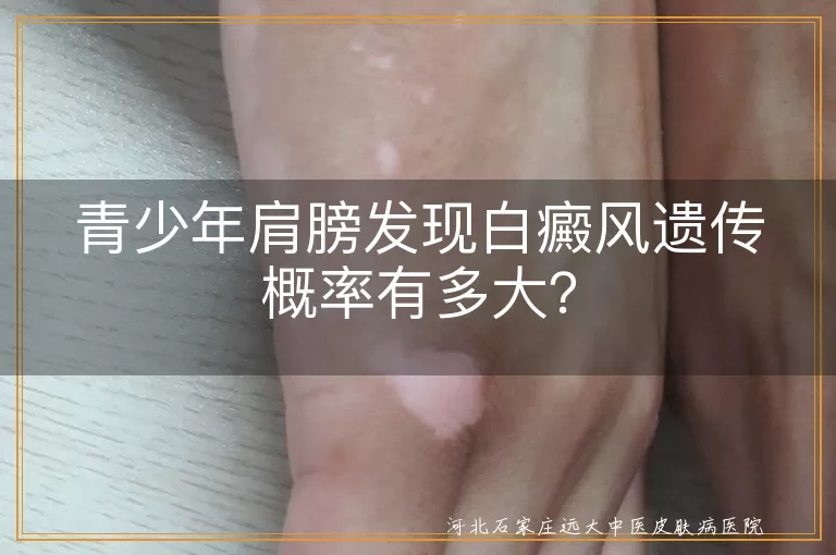 白癜风,遗传概率,青少年,环境因素,自身免疫,科学治疗