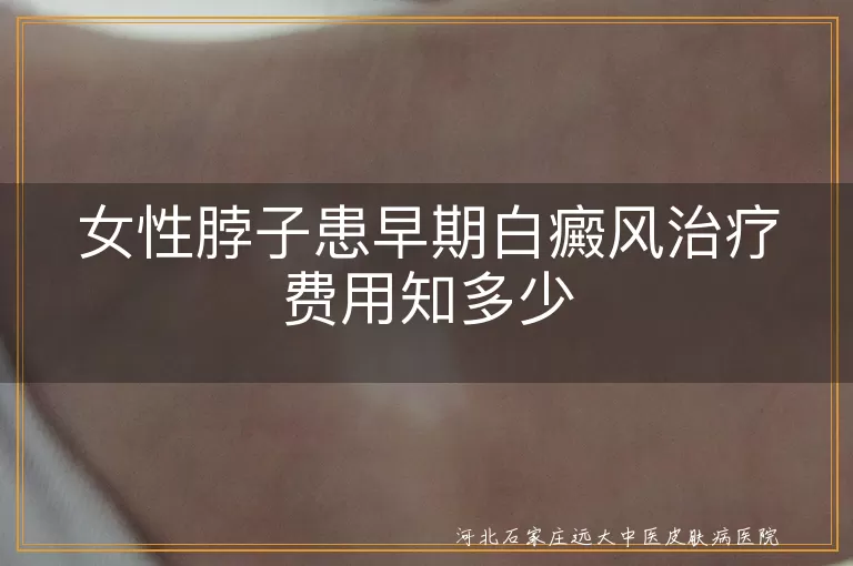 女性,脖子,早期白癜风,治疗费用,影响因素,节省费用,心态