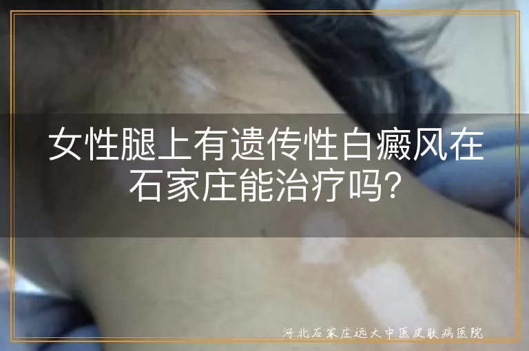 遗传性白癜风,石家庄治疗,专业医院,综合治疗方法,日常护理,良好心态