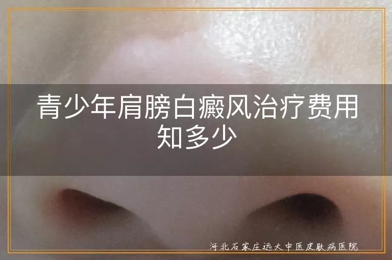青少年,白癜风,治疗费用,病情严重程度,治疗方法,医院选择,个人体质