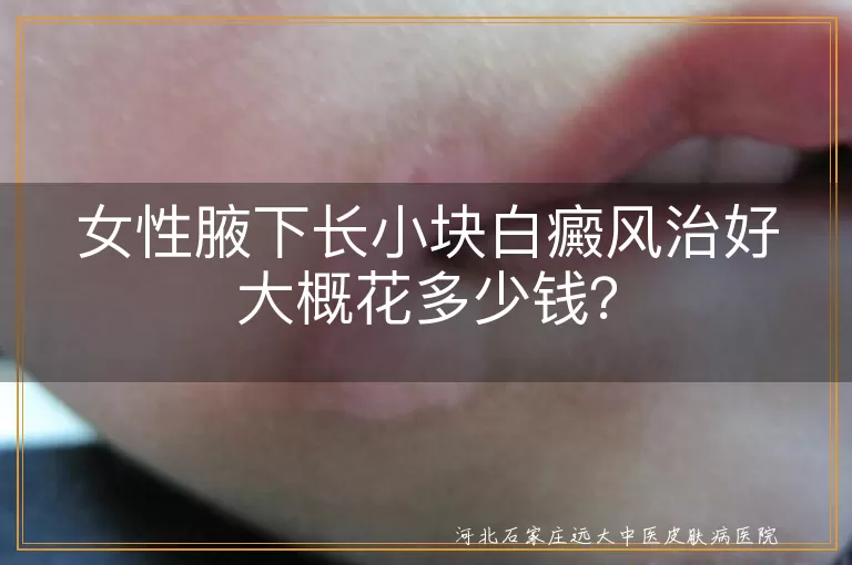 白癜风,腋下,治疗费用,病情严重程度,治疗方法,个人体质,医院等级,及早就医