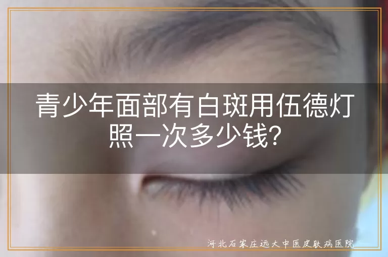 青少年,面部白斑,伍德灯检查,费用,医保报销,医院选择