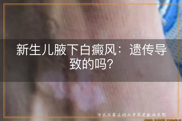 新生儿,白癜风,遗传,白斑,治疗,护理