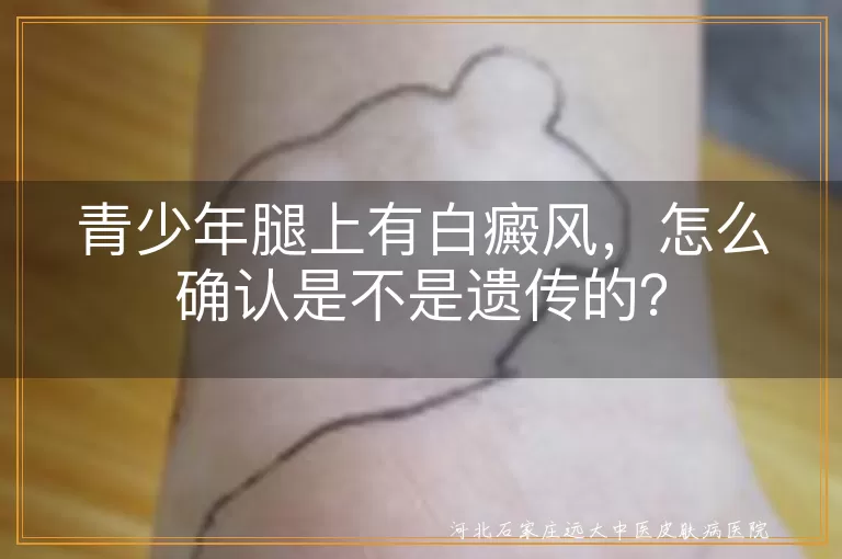 青少年,白癜风,遗传,家族史,发病时间,基因检测,医生判断,治疗,预防