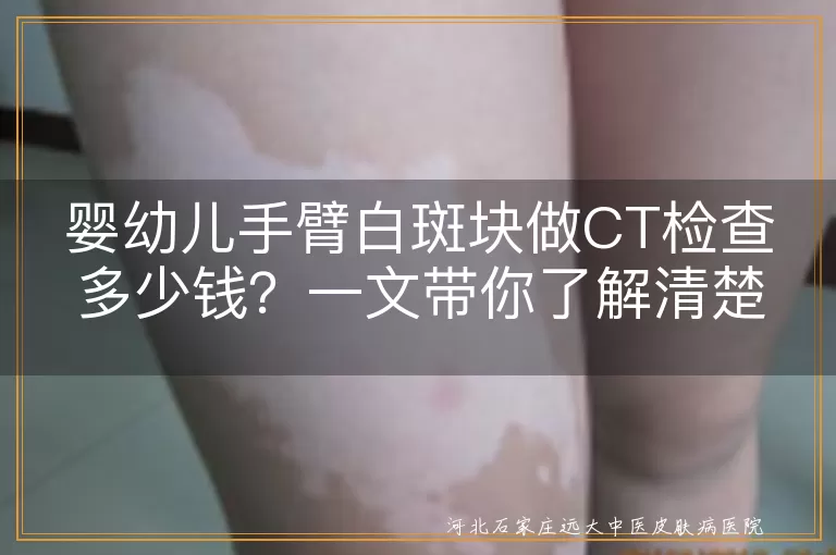 婴幼儿,白斑块,CT检查,费用,医院等级,病情,伍氏灯,皮肤镜
