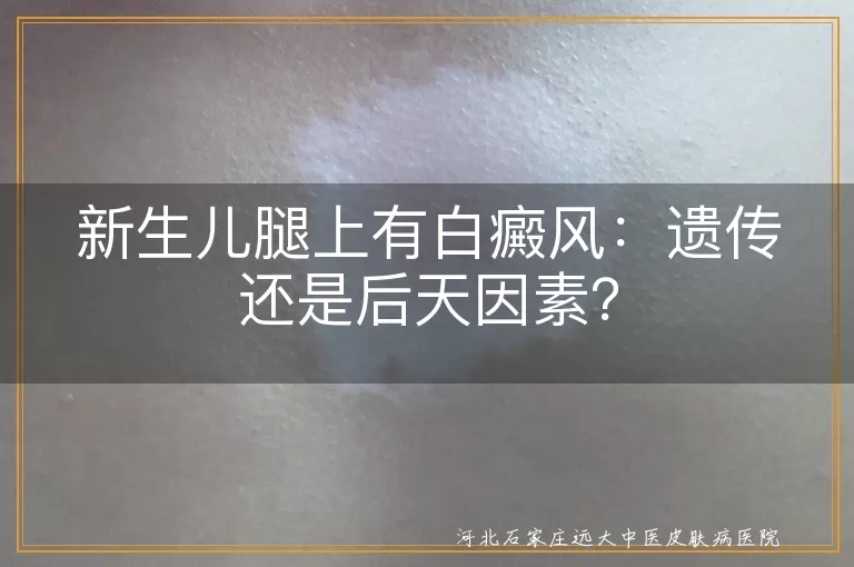 白癜风,新生儿,遗传因素,后天因素,营养不良,皮肤损伤,自身免疫异常,环境因素,心理关怀