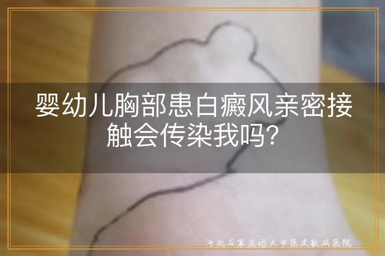 婴幼儿,白癜风,亲密接触,传染性,预防措施