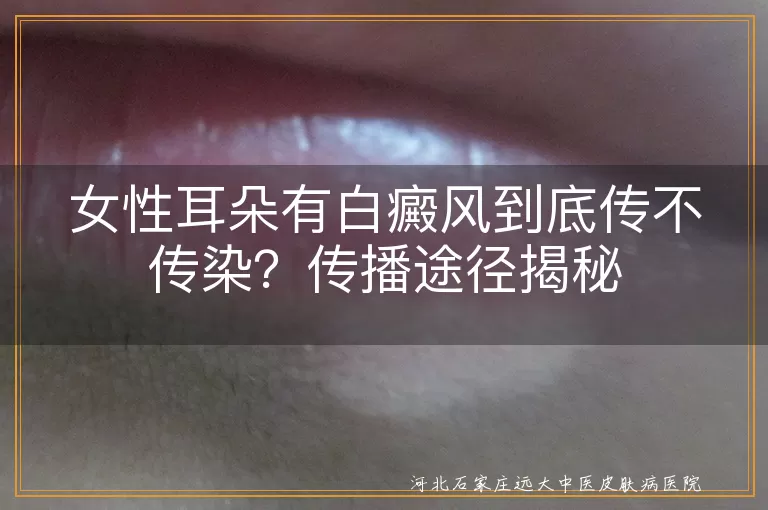 白癜风,传染,途径,治疗,女性耳朵