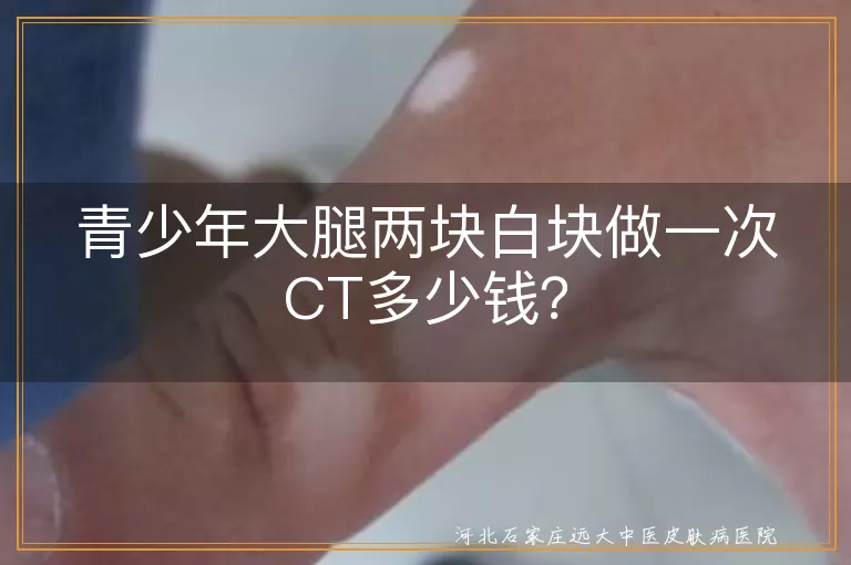 青少年,大腿白块,CT检查,费用,地区差异,医院级别,检查项目