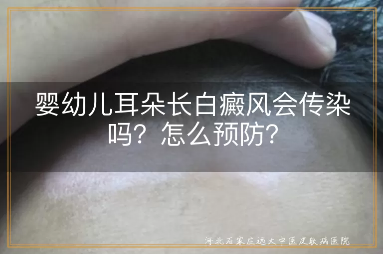 婴幼儿,白癜风,传染,预防,治疗