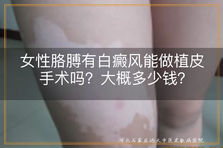 白癜风,植皮手术,费用,女性胳膊,复发,护理