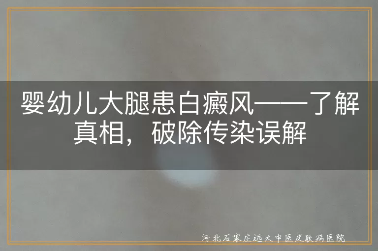 婴幼儿,大腿,白癜风,传染,遗传,自身免疫,外伤,科学护理