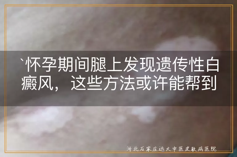 `孕期白癜风,遗传性,治疗方法,药物治疗,物理治疗,手术治疗,中医调理`