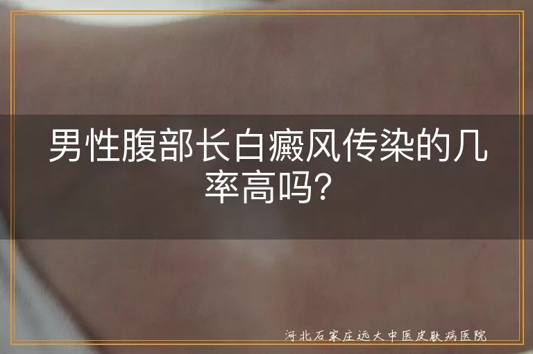白癜风,男性腹部,传染病,遗传,治疗,光疗,手术,日常生活注意事项