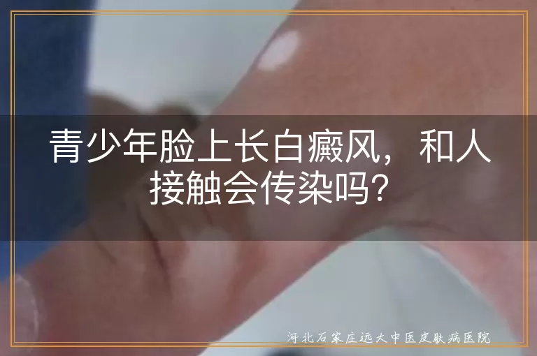 青少年,白癜风,传染,心理因素,科学治疗,生活调适