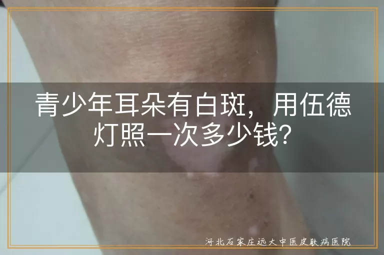 青少年,耳朵白斑,伍德灯,价格,诊断,治疗效果