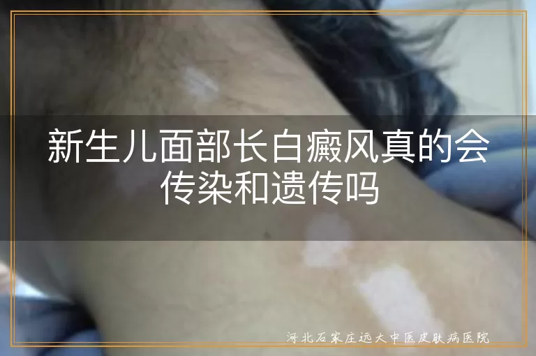 白癜风,传染,遗传,新生儿,面部,就医,护理,饮食,心理关怀