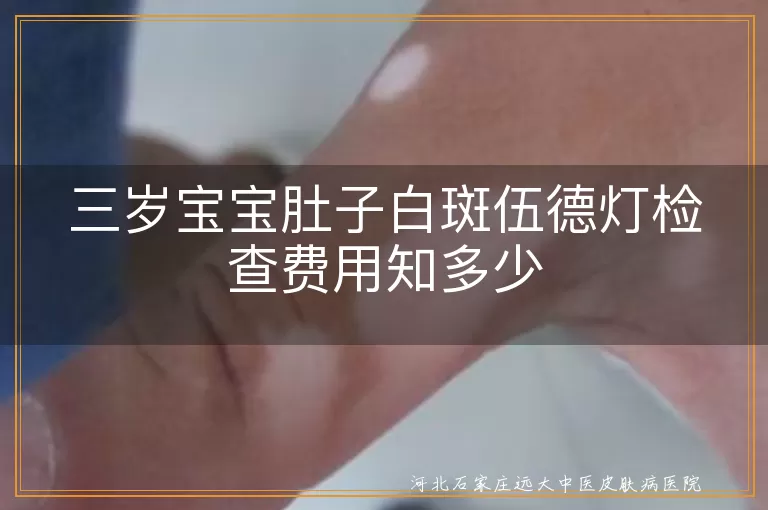伍德灯检查,白斑,宝宝,费用,医院级别,地区差异,性质范围