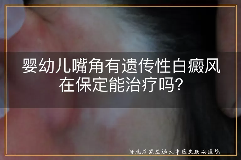 保定,婴幼儿,遗传性白癜风,治疗,医院,个性化方案,药物治疗,光疗,手术治疗,中医治疗