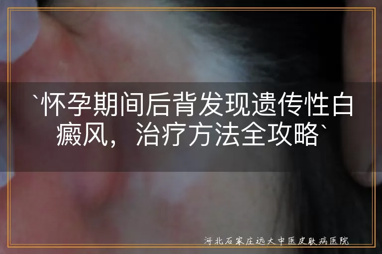 遗传性白癜风,怀孕,治疗,日常护理,局部用药,物理治疗,中医调理,食疗
