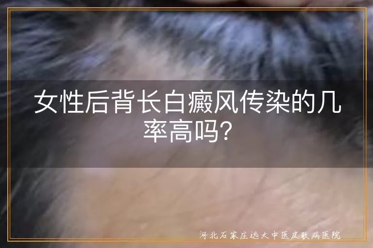白癜风,传染病,黑色素细胞,治疗,心理压力