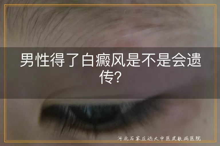 白癜风,遗传,男性,治疗,预防