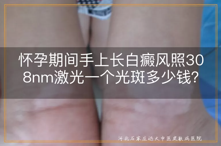 怀孕期间,白癜风,308nm激光治疗,光斑费用,地区差异,医院等级,白斑面积