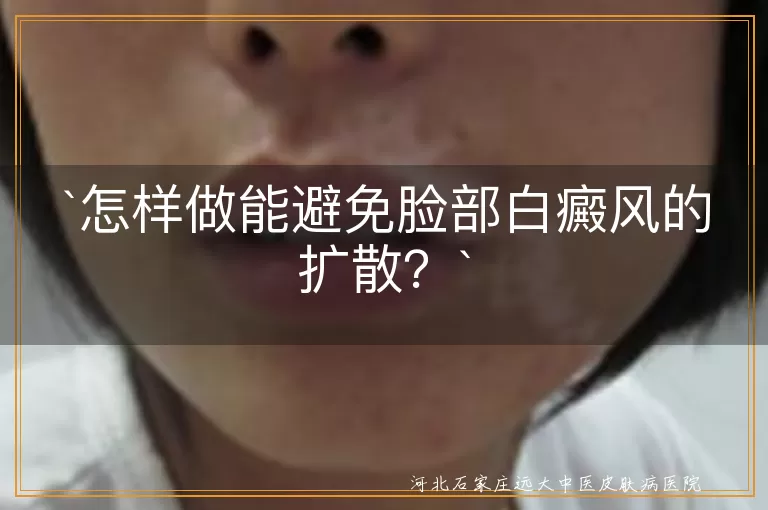 白癜风,脸部,扩散,预防,日常细节,皮肤检查,治疗方法,保湿,化妆品