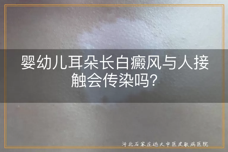 婴幼儿,白癜风,传染,治疗,心理关怀,日常护理
