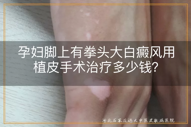 孕妇,白癜风,植皮手术,费用,治疗方式