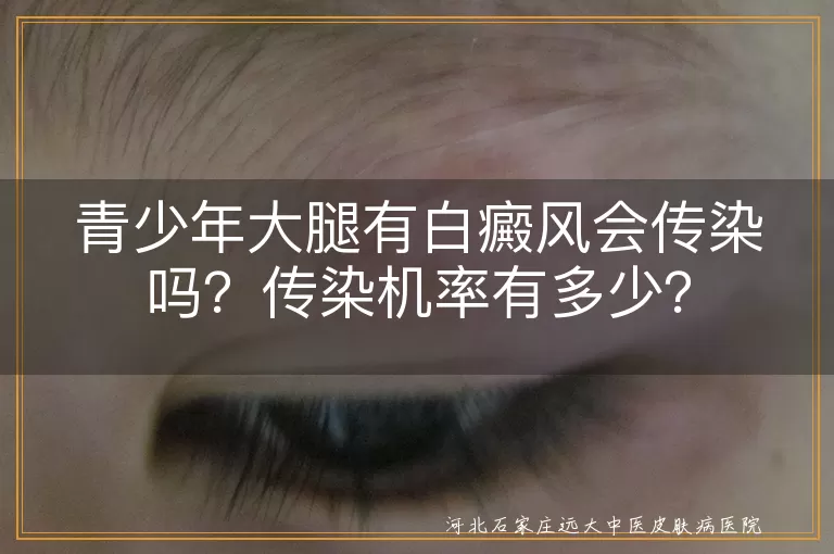 青少年,白癜风,传染,机率,治疗,护理