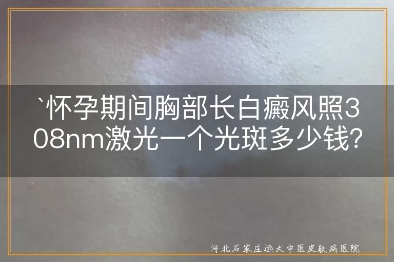 `怀孕期间 白癜风 308nm准分子激光 治疗费用 一个光斑多少钱`