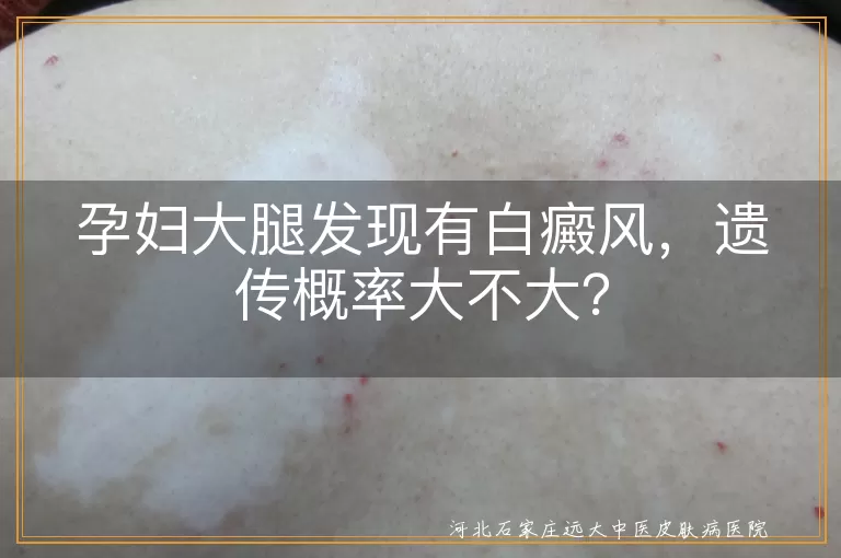 孕妇,白癜风,遗传概率,环境因素,预防措施
