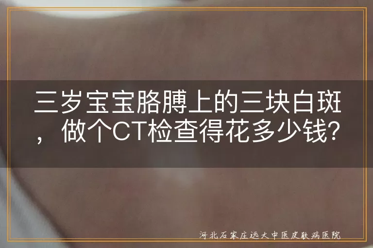 皮肤CT检查,白斑,费用,医院等级,地区差异,白癜风,花斑癣,白色糠疹