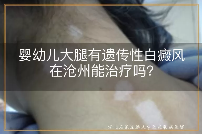 婴幼儿,遗传性白癜风,沧州,专业医院,治疗方法,家长支持,治愈率