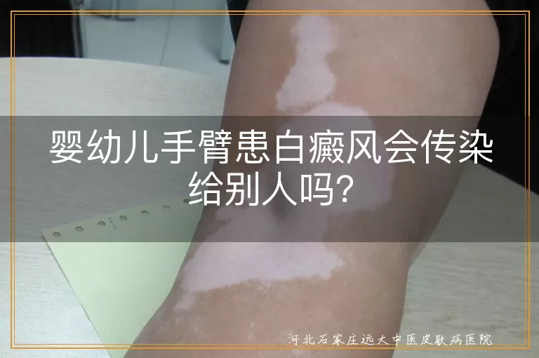 婴幼儿,白癜风,传染,治疗,心理健康