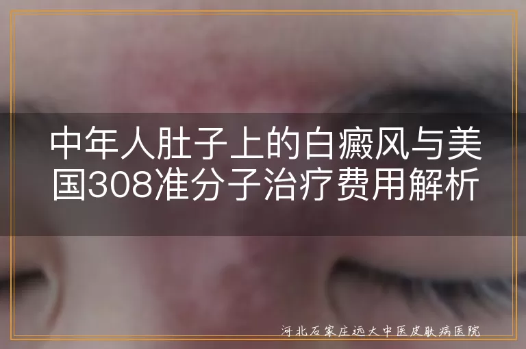 白癜风,美国308准分子激光,治疗费用,医院类型,病情严重程度