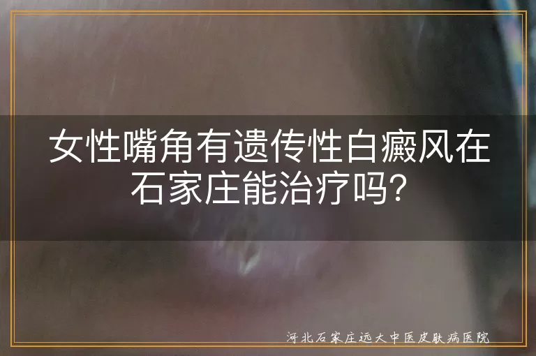 遗传性白癜风,石家庄,治疗,医院,药物,手术,物理疗法,生活习惯,心态,早期治疗