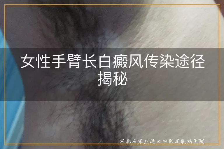 白癜风,传染途径,女性,手臂,自身免疫,遗传,治疗