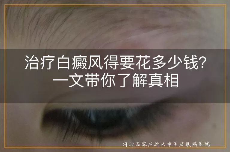 白癜风,治疗费用,病情严重程度,治疗方式,医院等级,经济水平,早期治疗,科学治疗
