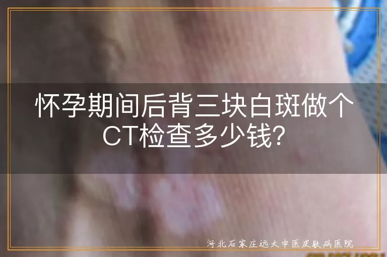 孕期白斑,三维皮肤CT,检查费用,白癜风,花斑癣,白色糠疹