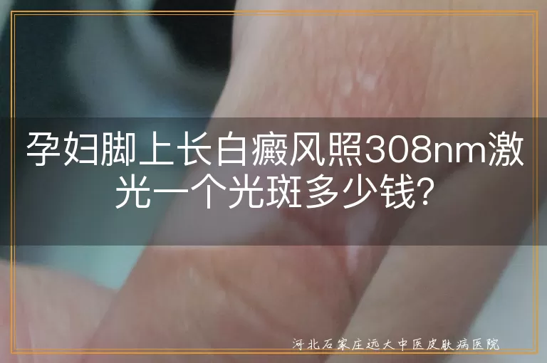 孕妇,白癜风,308nm激光,光斑费用,治疗安全